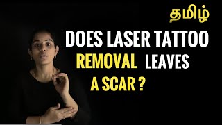 Tattoo Removal Laser services  Karachi tattoo 03332999499  DevilartstudioKarachi tattoo 03332999499 Devilartstudio