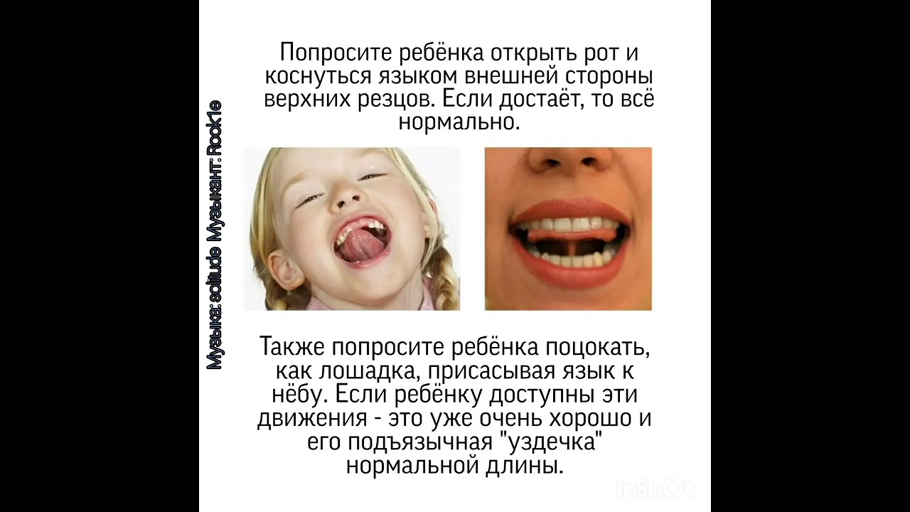Фото Уздечки Языка Ребенка