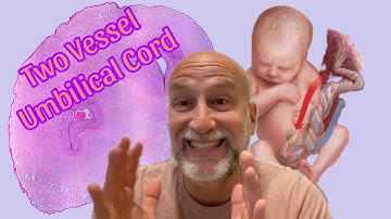 2 Vessel Umbilical Cord