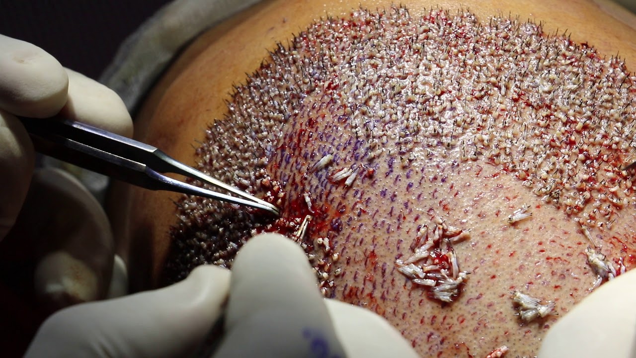 The Perils of Direct Hair Transplant DHT  Dr As Clinic