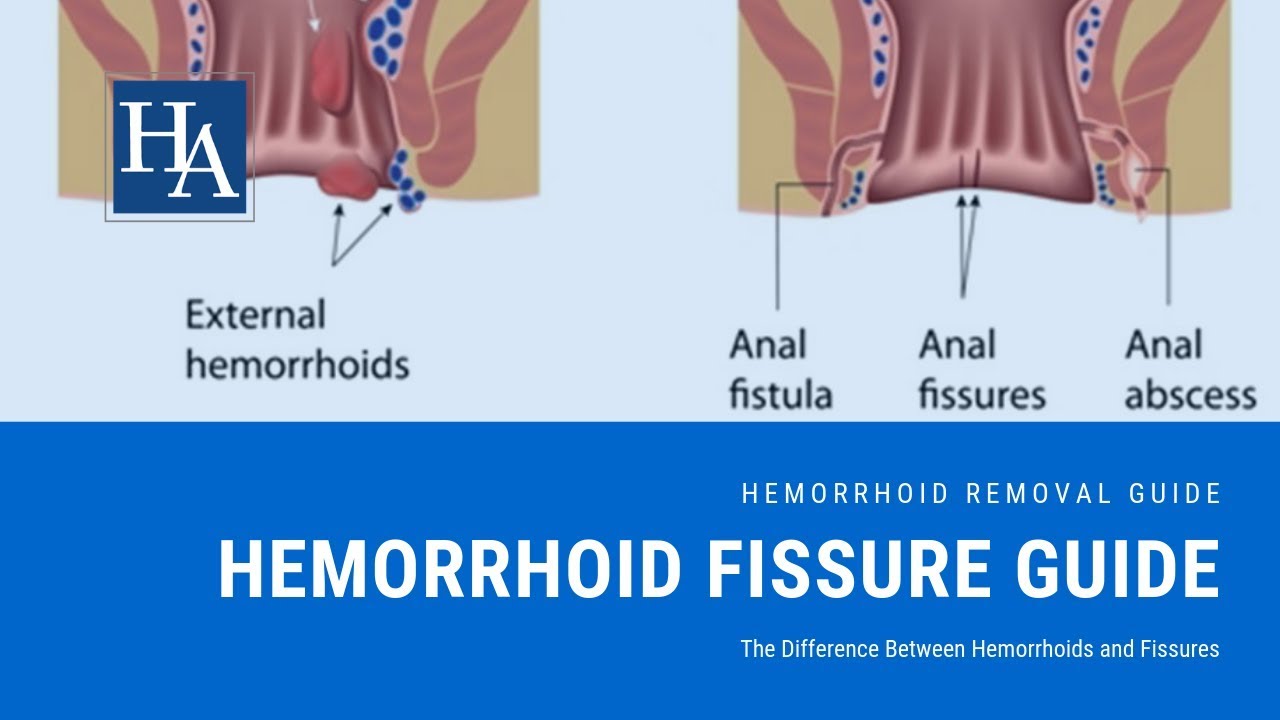 Hemorrhoid Fissure Guide The Difference Between Hemorrhoids And