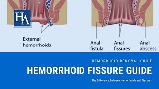Hemorrhoid Fissure Guide - The Difference Between Hemorrhoids and Fissures