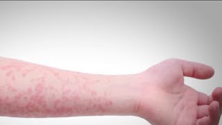 Young Northern Virginia Child Confirmed To Have Measles. Heres What To Know Nbc4 Washington