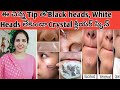 ఇలా Clean చేస్తే Blackheads/Whiteheads శాశ్వతంగా పోతాయి|| Deep Clean Clogged Pores At Home In Telugu