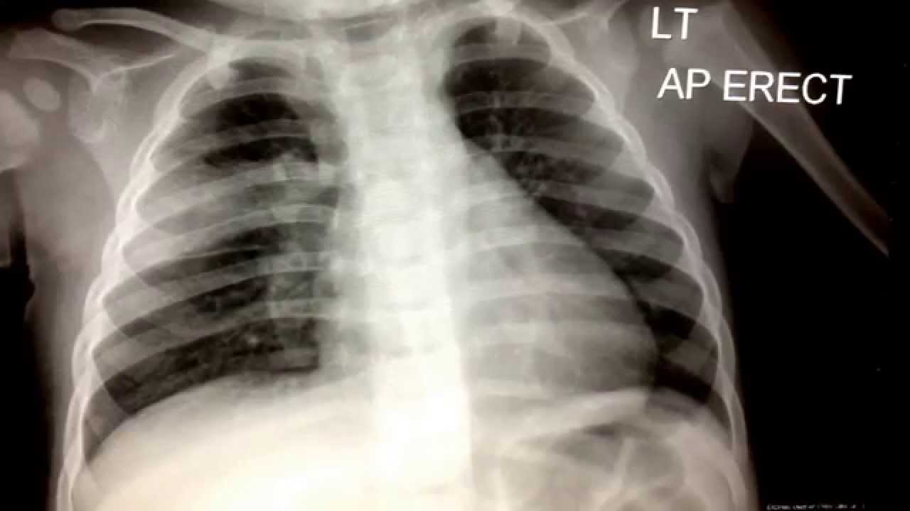 Abnormal pediatric chest X-ray - YouTube