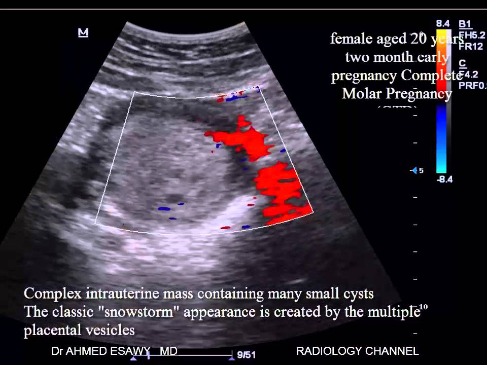 case presentation of molar pregnancy