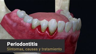Provenza Clínica Dental  Periodontitis: Síntomas, Causas y Tratamiento