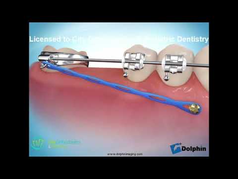 Mini Implant to Help Guide Tooth Movement | City Orthodontics & Pediatric Dentistry Edmonton