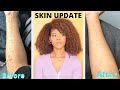 Getting Rid of Scars and Dark Spots | Lichen Planus Update