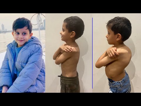 محمد الطفل اليمني اللي ابهر الجميع بعد جراحة تصليح اعوجاج و تحدب خطير بالعمود الفقري