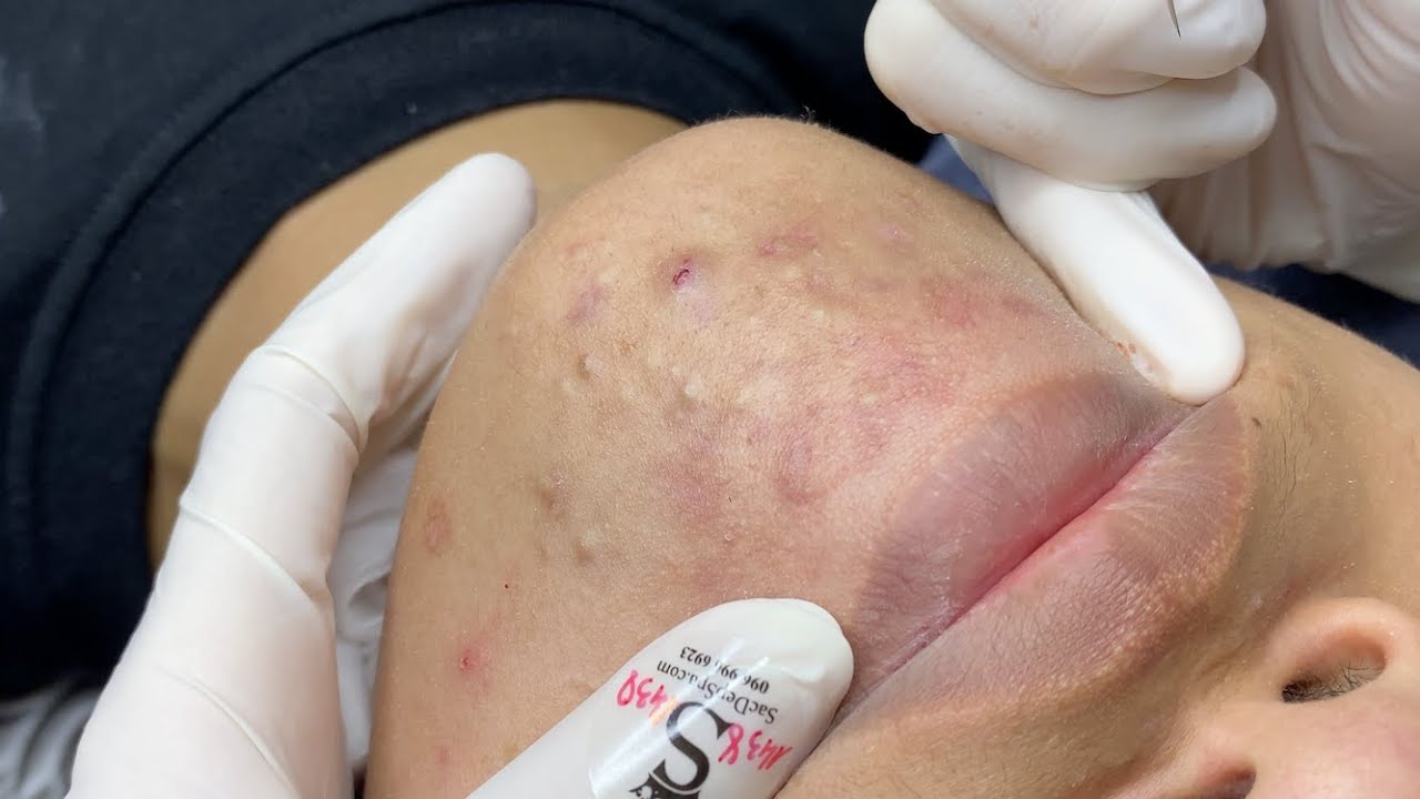 SAC DEP SPA Blackheads | #524