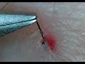 Ingrown Hair 埋没毛の救出!PART10