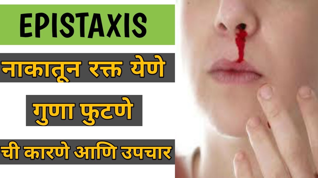 Epistaxis in marathi । nakatun rakt yene upay marathi । नाकातुन रक्त
