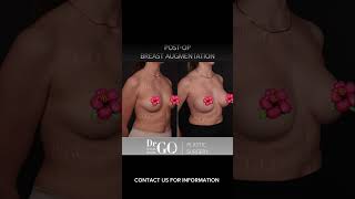 Before and After Breast Augmentation #breastaugmentationsurgery #drgo