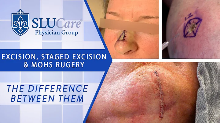 The Difference Between Excision, Staged Excision & Mohs Surgery for removing skin cancer
