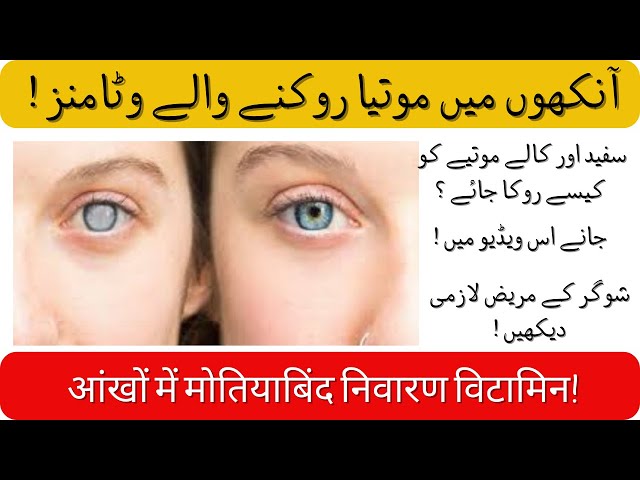 5 Best Vitamins For Eye Protection | Cataract | Glaucoma | Details in Urdu/Hindi