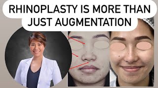 Rhinoplasty is more than just augmentation.