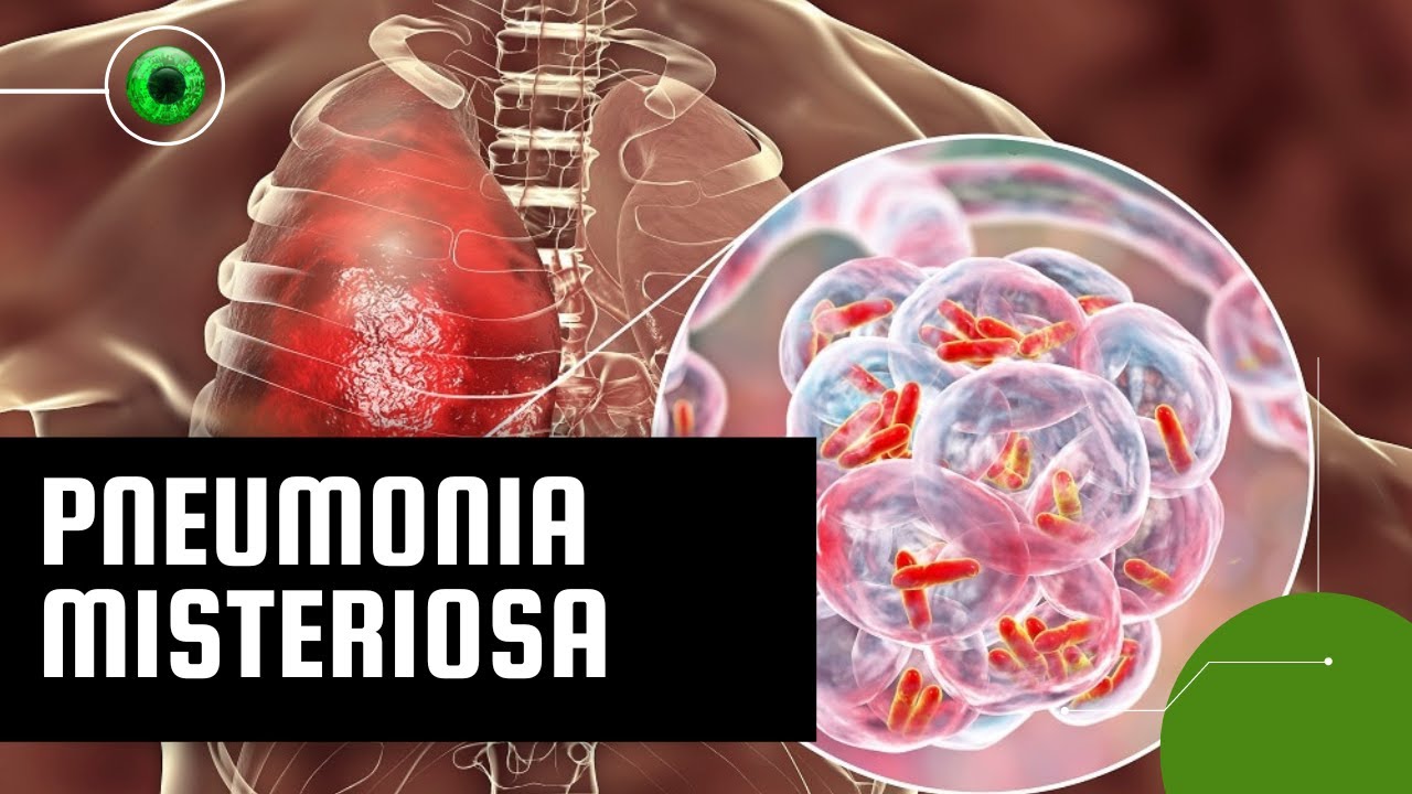 Pneumonia fatal na Argentina: cientistas descobrem motivo de surto