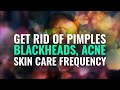 Get Rid of Pimples, Blackheads, Acne | Rife Frequency Treatment | Skin Care Frequency Binaural Beat