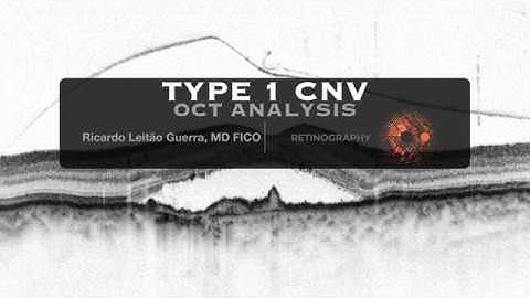 Type 1 CNV - OCT analysis