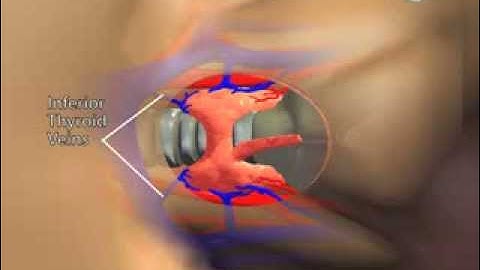 Surgery for Thyroid Disease: Minimally Invasive Thyroid Lobectomy