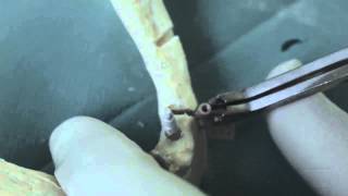 Procedure to implant B001 - Bd