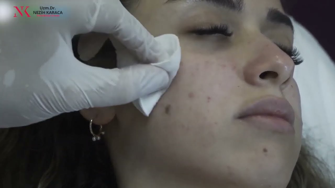 Doktor Eğitimleri 2: Gözaltı Dolgu Uygulaması (Doktorlar İçindir)