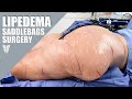 Lipedema reduction surgery thighs  buttocks  total lipedema care