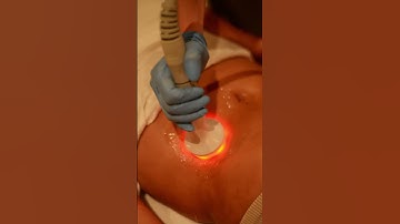 The HVN Cavitation