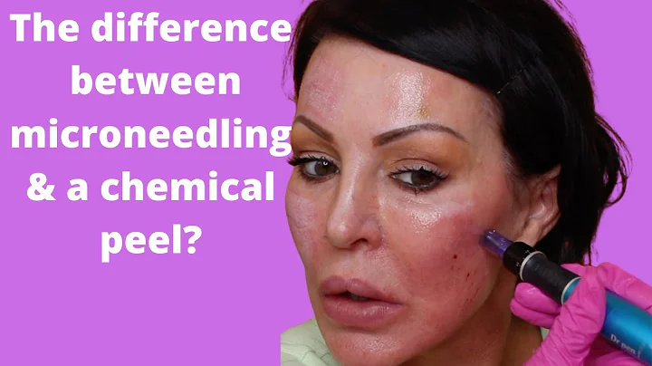 The difference between micro-needling and a chemical peel?