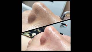 Глубокая чистка лица до и после #косметолог #kosmetologia #аёллар #юз #turkey #фойдали #чисткалица Глубокая чистка лица до и после #косметолог #kosmetologia #аёллар #юз #turkey #фойдали #чисткалица