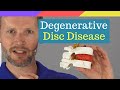 Explained: Degenerative Disc Disease