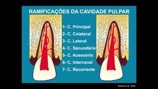 Abertura Coronária e Preparo do Canal Radicular