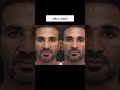 صور مشاهير قبل وبعد عمليات التجميل اكسبلور