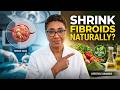 Can Fibroids Shrink Without Surgery? Find Out
