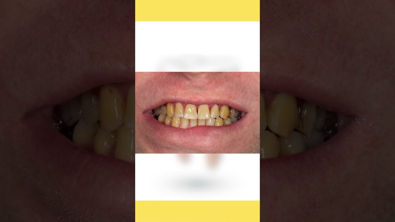 Yellow Teeth Home Remedies. Yellow Teeth ko White Kaise Kare. #xarry #shorts