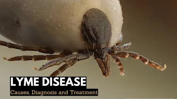 Lyme Disease, Causes, Signs and Symptoms, DIagnosis and Treatment.