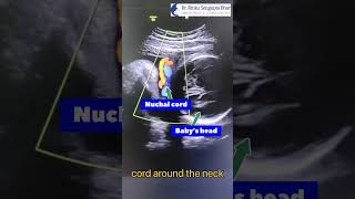 Cord around the Neck at 32,35,37 weeks | Is Normal Delivery Possible