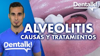 INFECCIÓN tras extracción dental: ALVEOLITIS – Tratamiento, síntomas y causas | Dentalk! ©