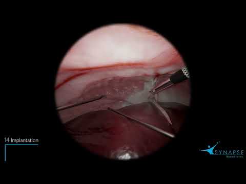 NeuRx Diaphragm Pacing System® Implantation Procedure Video - video from Synapse Biomedical