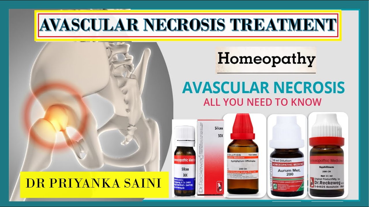 AVASCULAR NECROSIS/ OSTEONECROSIS (हड्डियों का गलना )| HOMEOPATHY TREATMENT @Dr Priyanka Homeopathy