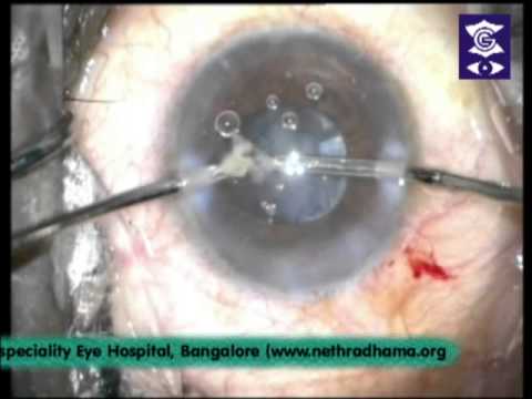 Dr. Suhas Haldipurkar - Live Surgery