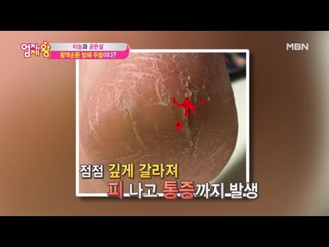 발 혈액순환 방해하는 &rsquo;이것&rsquo;의 정체는?!