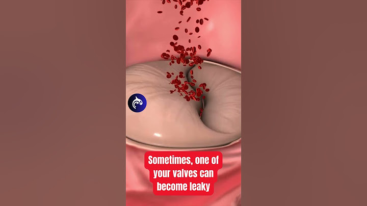 Do you have a leaky Heart Valve? See how it's fixed.🫀 #heartbeat #anatomy #medicalanimation