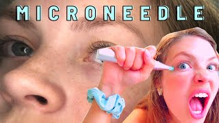 Deminuage Review ~ The Most Gentle Microneedling