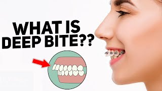 What is an overbite : deep bite https://www.straightsmilesolutions.com/