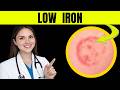 14 Visible Signs of Iron Deficiency Most People Ignore | Doctor Explains