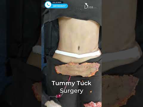 Tummy Tuck Surgery | Immediate Before and After Results #shortsfeed