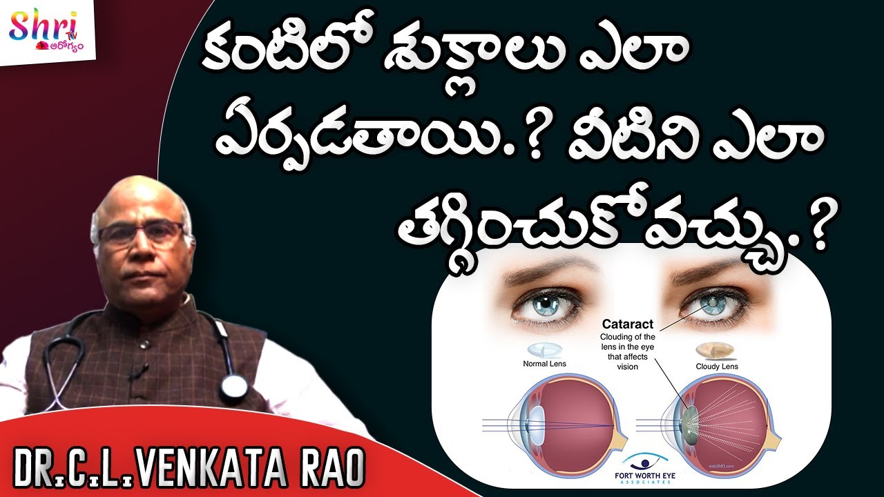 What are the causes of Cataracts? || కంటిలో శుక్లాలు ఎలా ఏర్పడతాయి || Shri Tv Arogyam