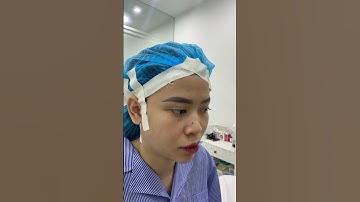 Nâng Mũi Cấu Trúc Sau 1 Năm Đã Thay Đổi Tôi Thế Nào ? #nangmui #nangmuicautruc #drlongck1pttm